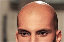 Gene link to rare cause of baldness