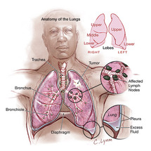 Study links lung cancer death to menopause hormones Study links lung cancer death to menopause hormones
