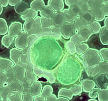 First stem cell transplant on Chilean leukemia patient First stem cell transplant on Chilean leukemia patient