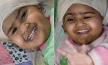 Separated twins beat the odds in remarkable survival story Separated twins beat the odds in remarkable survival story