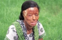 India acid attack victim who became a TV millionaire