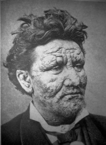Leprosy: an ancient disease thrives in 21st century Leprosy: an ancient disease thrives in 21st century