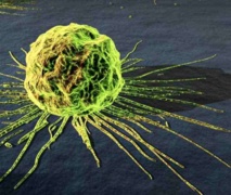 Risk calculator boosts odds of finding lung cancer Risk calculator boosts odds of finding lung cancer