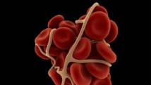 Blood clot removal boosts stroke risk in heart attack patients Blood clot removal boosts stroke risk in heart attack patients