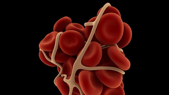 Blood clot removal boosts stroke risk in heart attack patients
