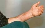 World's first hands, face transplant