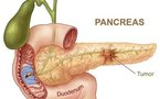 Early obesity raises pancreatic cancer risk