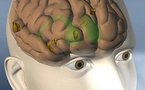 Scientists help stroke victims regain speech through singing