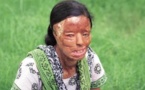 India acid attack victim who became a TV millionaire