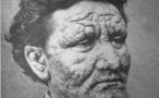 Leprosy: an ancient disease thrives in 21st century