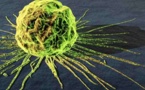Risk calculator boosts odds of finding lung cancer