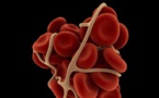 Blood clot removal boosts stroke risk in heart attack patients